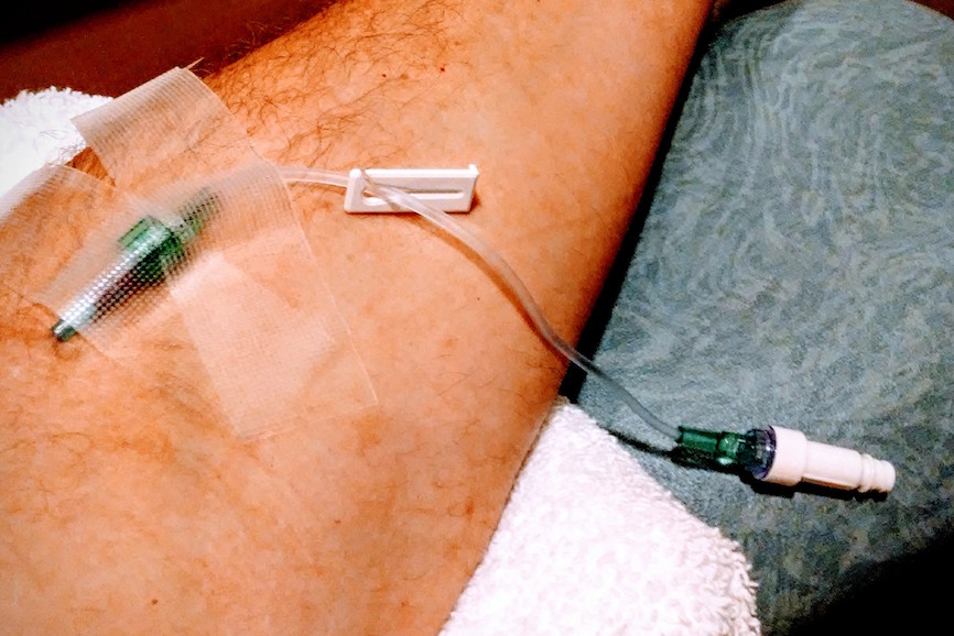 Jeffrey Poehlmann, with IV in his arm